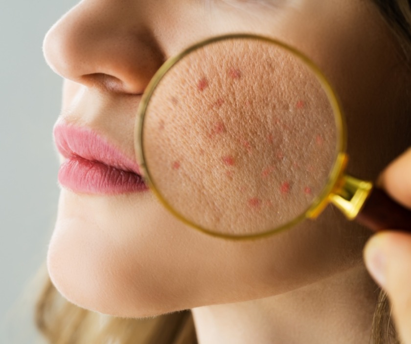 spa trị mụn quảng ngãi địa chỉ nặn mụn uy tín Quảng Ngãi